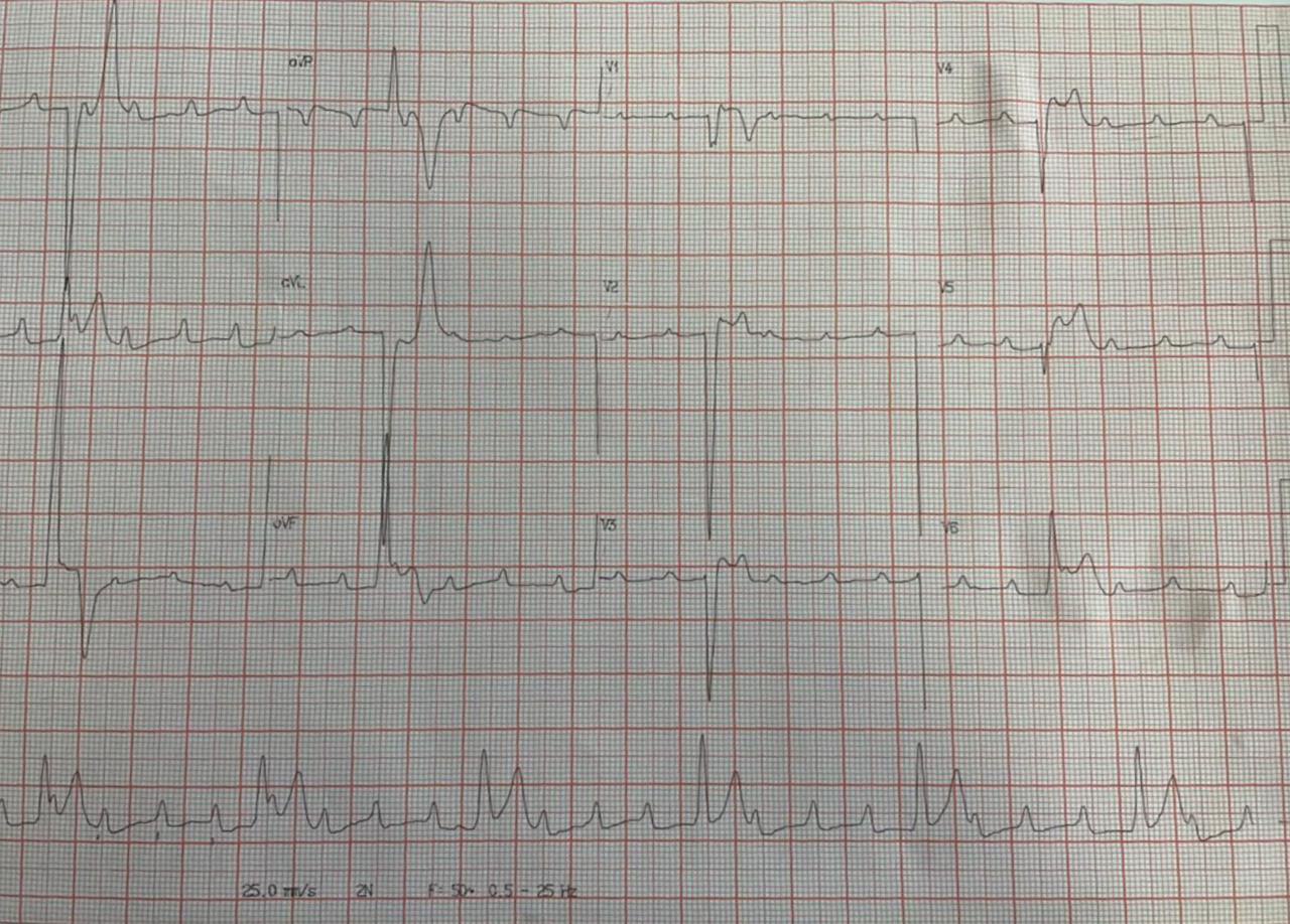 Paciente masculino de 56 años, sin factores de riesgo coronario, cursando Covid 19 con empeoramiento de la afección respiratoria y necesidad de intubación y CCG con CD mostrando la rama del NAV ocluído com presencia de trombo
