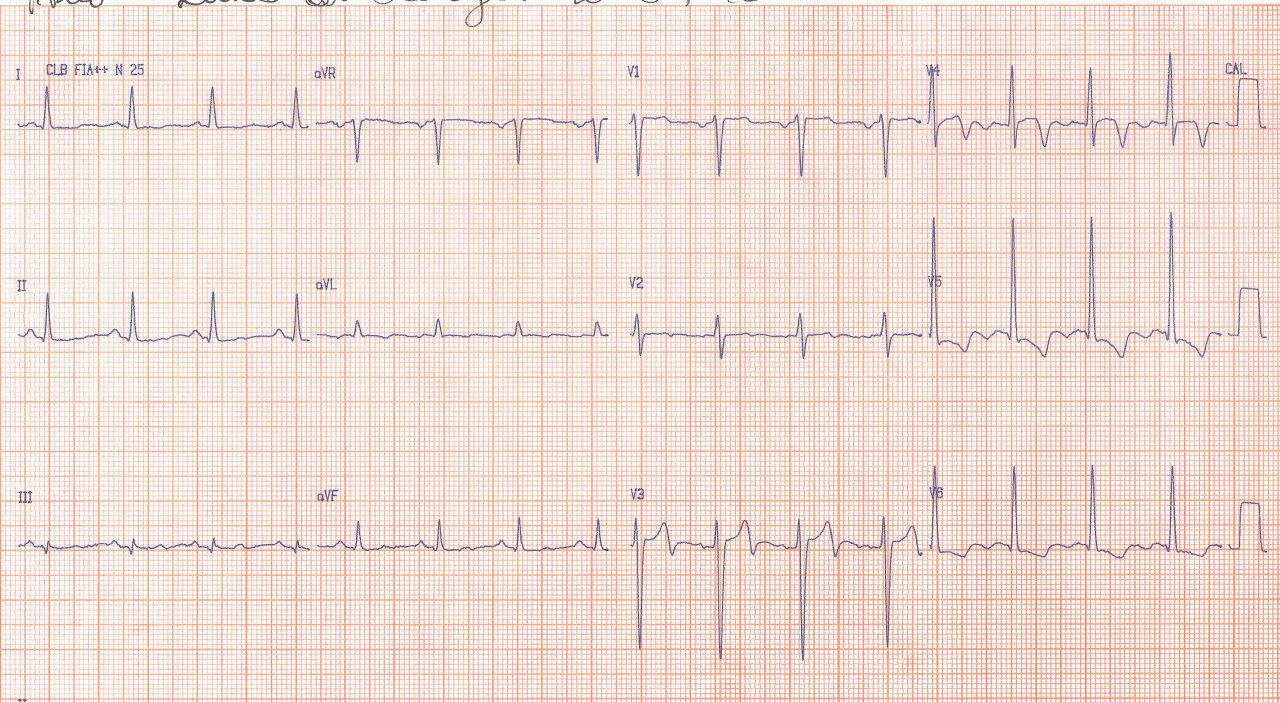 Paciente con SCA que presenta patrón de Wellens por compromiso de la DA proximal