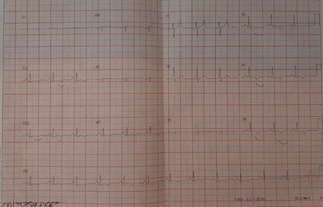 Mujer de 80 años con antecedente de Infarto ínfero-lateral asintomatlco, que presenta un hallazgo sospechoso en Rx de tórax de control por el COVID, que en la TAC se corresponde con la presencia de un pseudo aneurisma de VI con un trombo en su interior