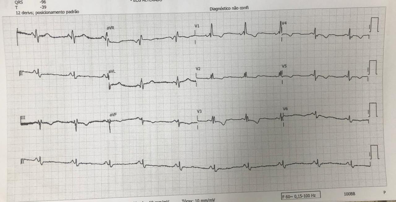 Paciente con dolor precordial atípico que presenta aneurisma apical que permite establecer el diagnóstico de miocardiopatía chagásica