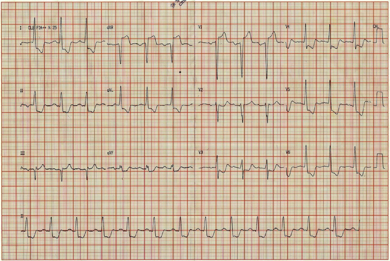 Varón de 69 años, HTA, DBT, dislipémico, con episodios de ángor recurrente que presenta episodio de gran intensidad, en quién se ausculta soplo sistólico aórtico 3/6 irradiado a cuello, con CCG normal