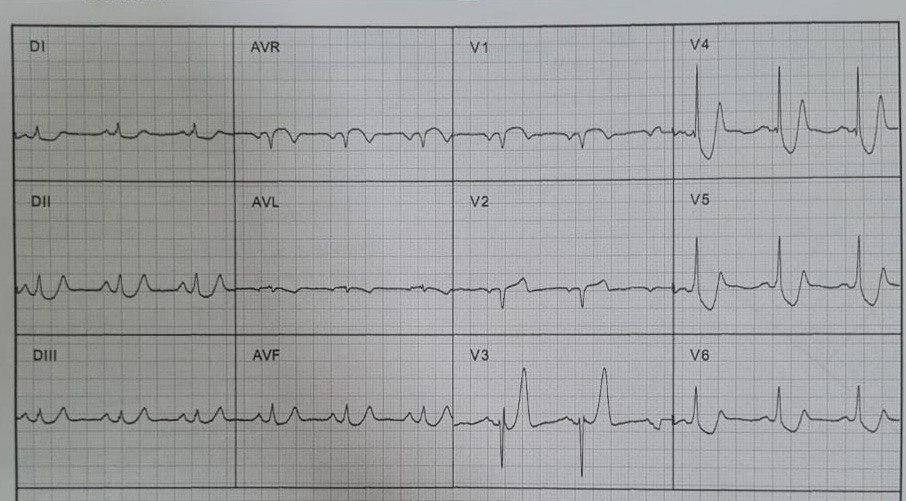 Paciente de 63 años con antecedente de IAM previo que presenta dolor precordial severo cuyo ECG muestra un patrón de Winter