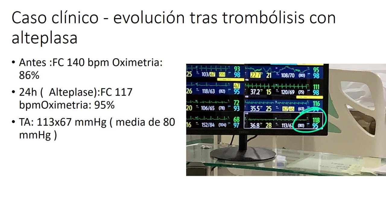 Paciente obeso de 46 años, con COVID 19, con una saturación de 86% por lo cuál recibe ventilación mecánica, observándose en el ECO 2D VD dilatado e hipocontráctil con el tabique interventricular en forma de letra D, que es trombolizado con alteplase por diagnóstico de TEP, con franca mejoría