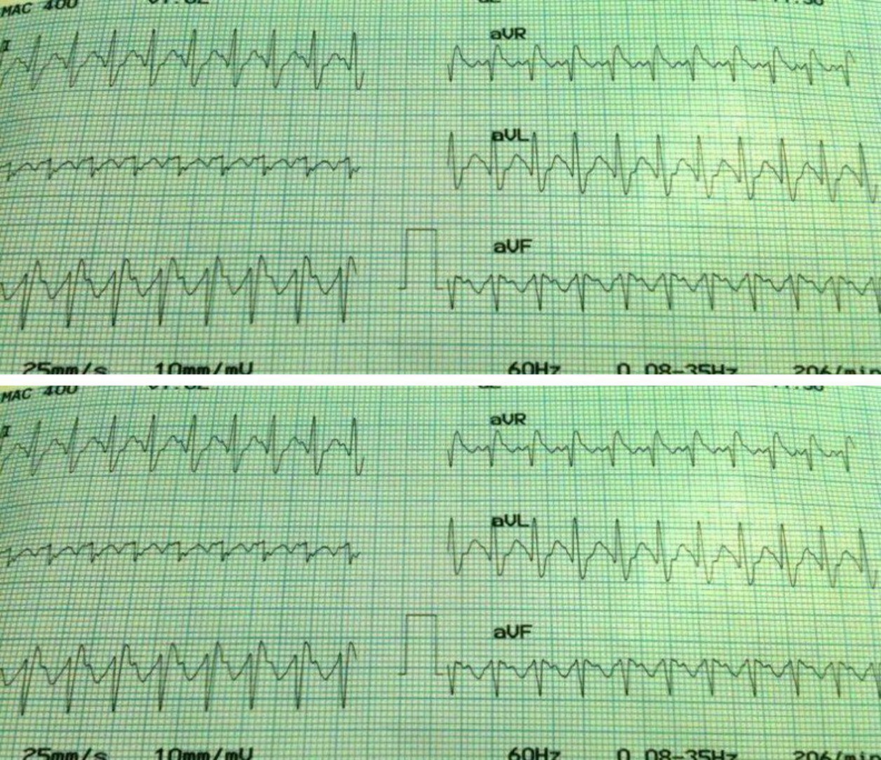 Paciente con BRD previo que refiere palpitaciones por TRAVO que no responde al MSC ni a la adenosina en portador de BIA-A