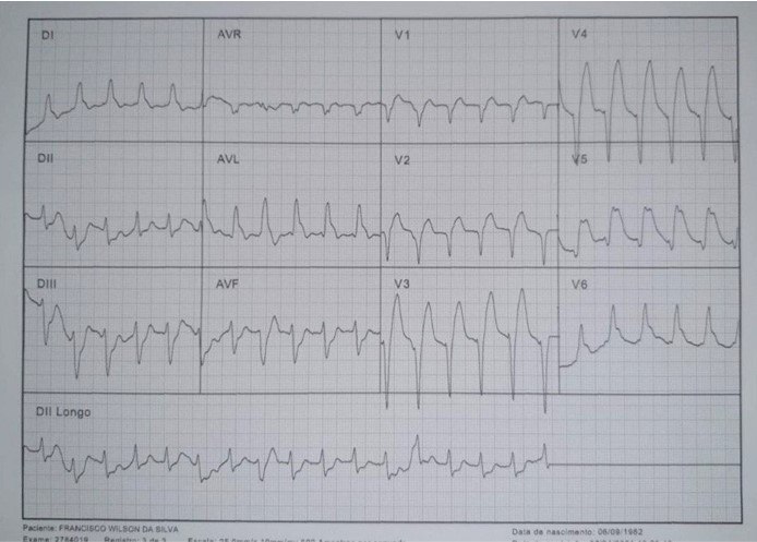 Paciente con dolor toráccico severo y repentino que evoluciona a FV de la cual es reanimado cuyo ECG presenta ondas lambda en DI, aVL y V6 con imagen de QRS triangular por oclusión de la DA