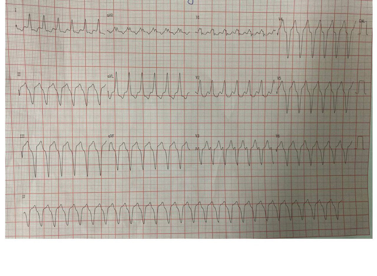 Paciente con historia previa de enfermedad coronaria que presenta TV con signo de Marriott (Orejas de conejo) con presencia de una escara ínferolateral