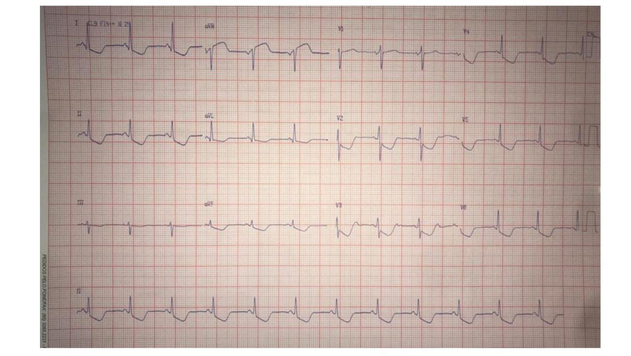 Mujer de 54 años con cuadro de hipotensión súbita y pérdida del conocimiento con presencia de midriasis, realizándose TAC que pone de manifiesto hemorragia subaracnoidea (HSA) y edema cerebral difuso