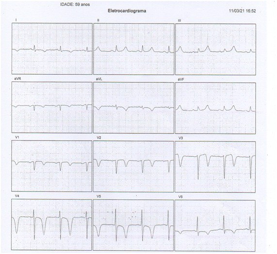 Varón de 59 anõs que presenta un IAM anterior 40 días previos, con DA = 100% proximal ocluída, siendo tratado con  implantación de 2 stents, sin lesión residual