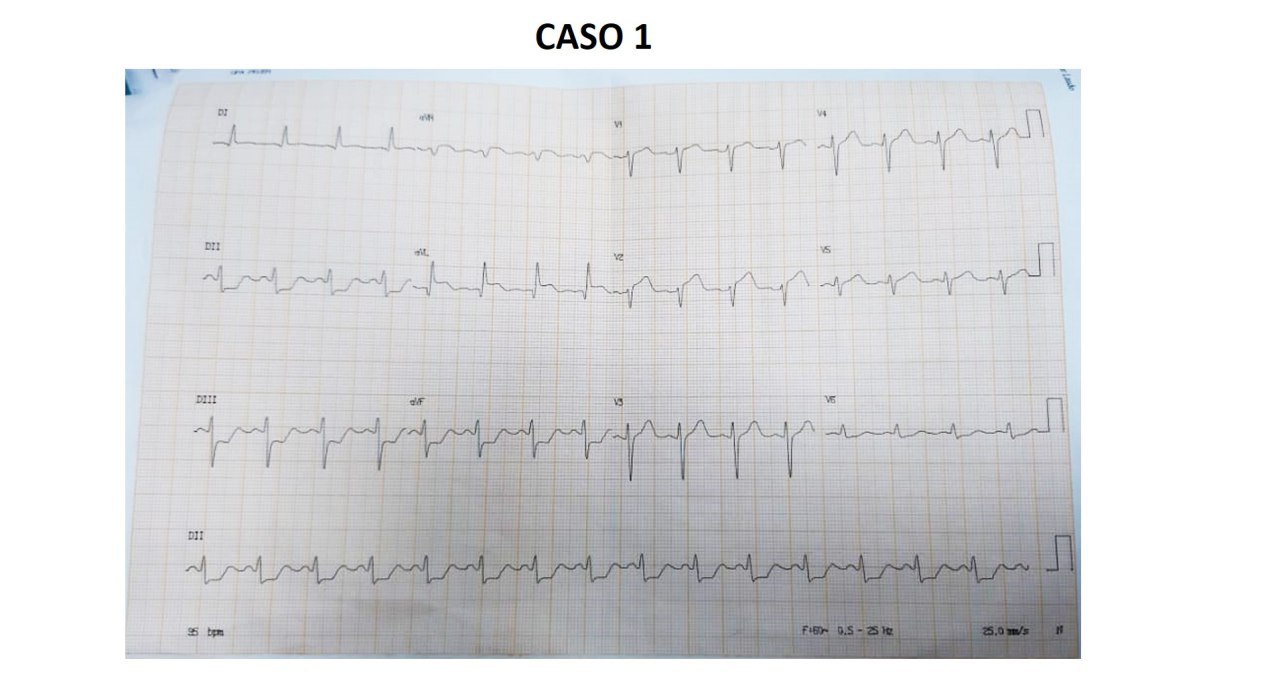 Paciente cursando SCA por compromiso de la arteria 1º diagonal, lo cuál se evidencia por la elevación del segmento ST en las derivaciones I y aVL, cuando no se asocia con depresión del segmento ST en V1-V2
