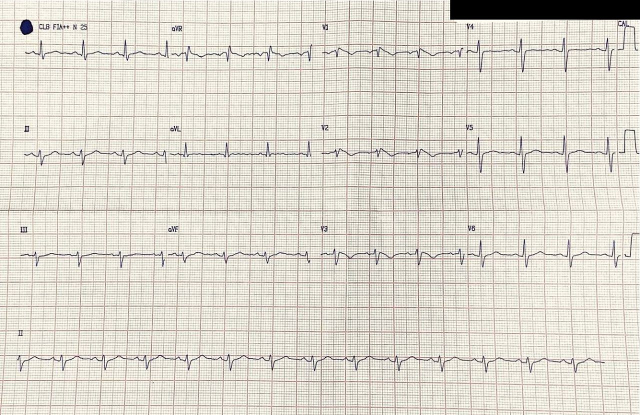 Paciente de 60 años cursando cuadro de COVID 19 en cuyo ECG se observa imagen compatible con fenocopia de Brugada