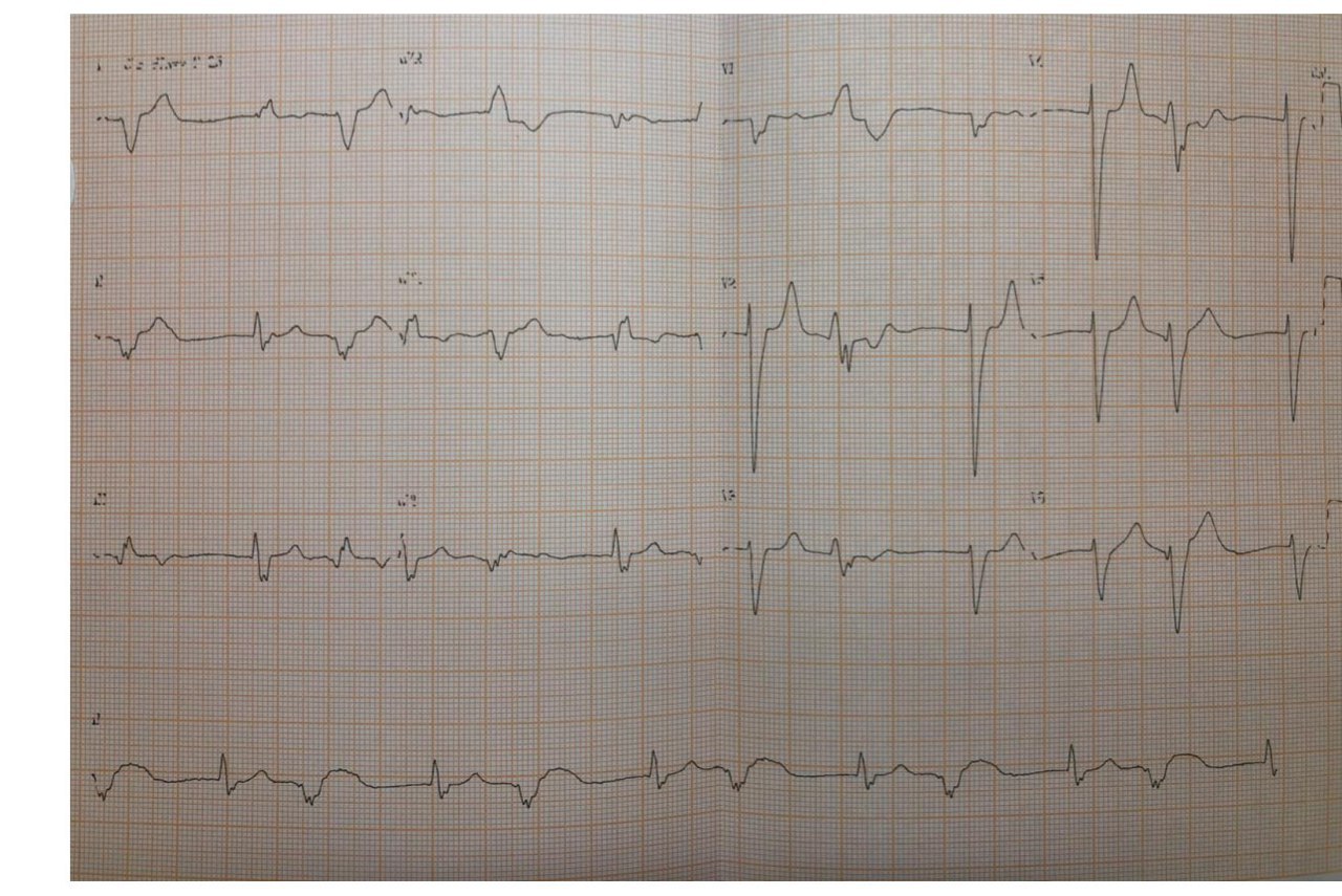 Paciente chagásico con Insuficiencia cardíaca en estadio D que presenta fibrilación auricular con ritmo de escape de la unión y bigemismo ventricular.