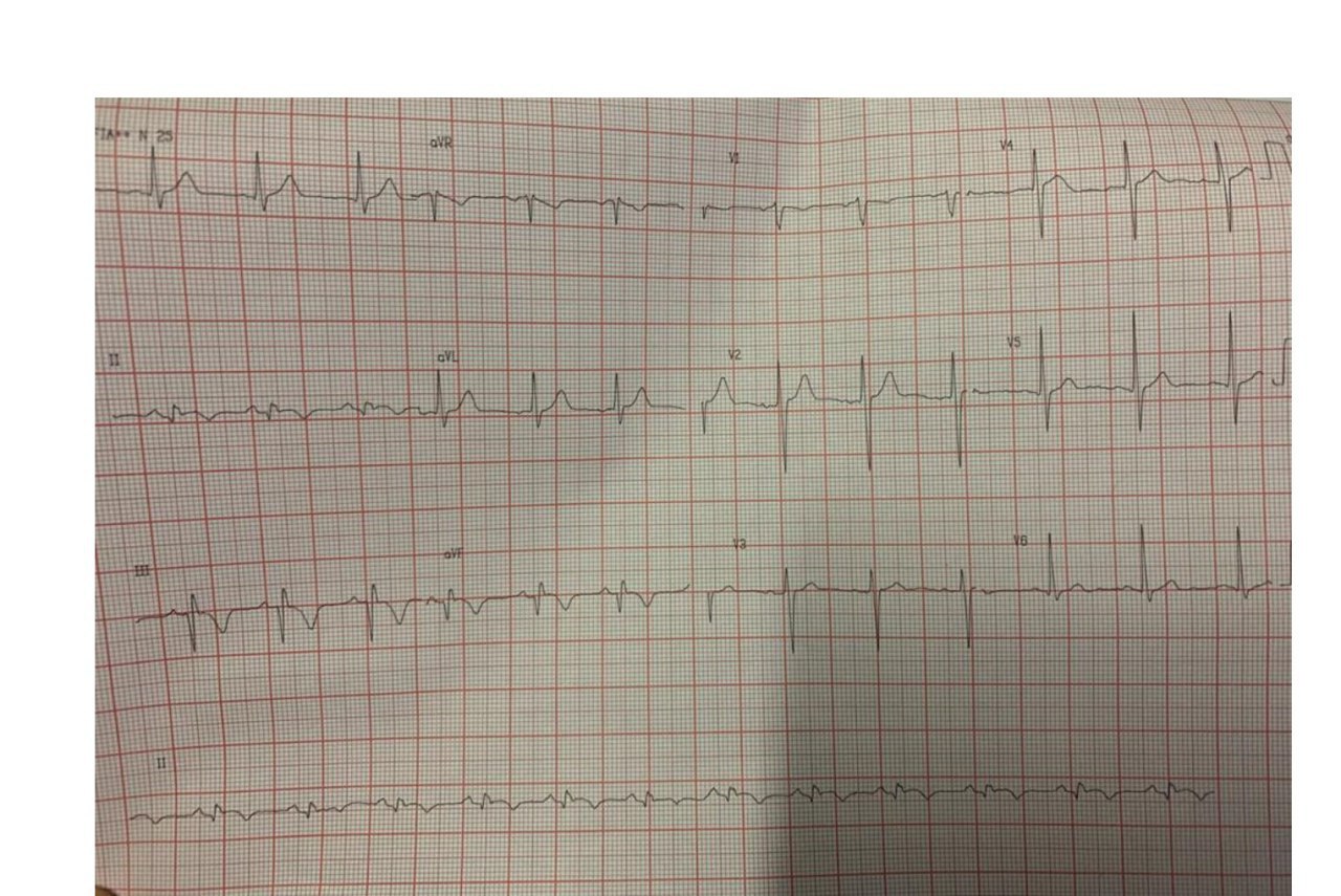 Paciente varón de 40 años ingresado con IAMCEST inferior cuya CCG mostró una CD ocluida con alta carga trombótica, llenando el lecho distal por colaterales de la arteria coronaria  izquierda.