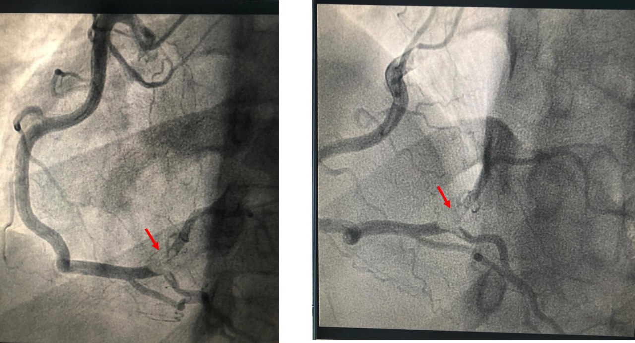 Paciente de 33 años sin factores de riesgo de enfermedad coronaria, consumidor de bebidas energizantes, que presenta episodio de ángor en febrero / 2021 durante un partido de fútbol cuyo ECG presenta supradesnivel ST inferior.