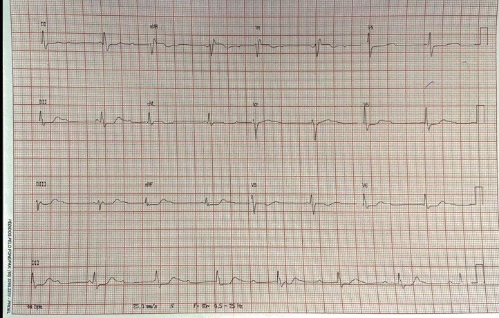 Mujer de 55 años, HTA y DBT con antecedentes de insuficiencia cardíaca, medicada con antidepresivos tricíclicos, que presenta episodios sincopales precedidos por palpitaciones, que presenta hipocinesia difusa grave con fracción de eyección del 35%, CCG normal. con prolongación del QT a quién se implanta MP transitorio, hizo también una TV monomórfica que muestra un sustrato irreversible.