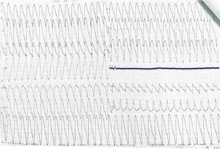 Paciente de 43 años, HTA con sobrepeso, bebedor social, que presenta episodio de ángor y taquicardia de QRS ancho que revierte espontáneamente, cuya CCG mostró una CD ocluida con colaterales de la arteria DA, que presentaba una obstrucción del 90% en el tercio medio.