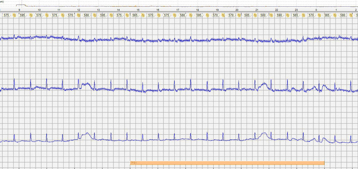 Paciente de 73 años con TPSV que revierte a bradicardia sinusal,que presenta un BIA-A, constituyendo un  síndrome de Bayes