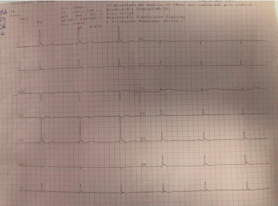 Mujer 56 años internada con neumonía por COVID-19  por lo cuál debió ser intubada, presentando bradicardia sinusal extrema, hipotermia y con ondas de Osborn en el ECG