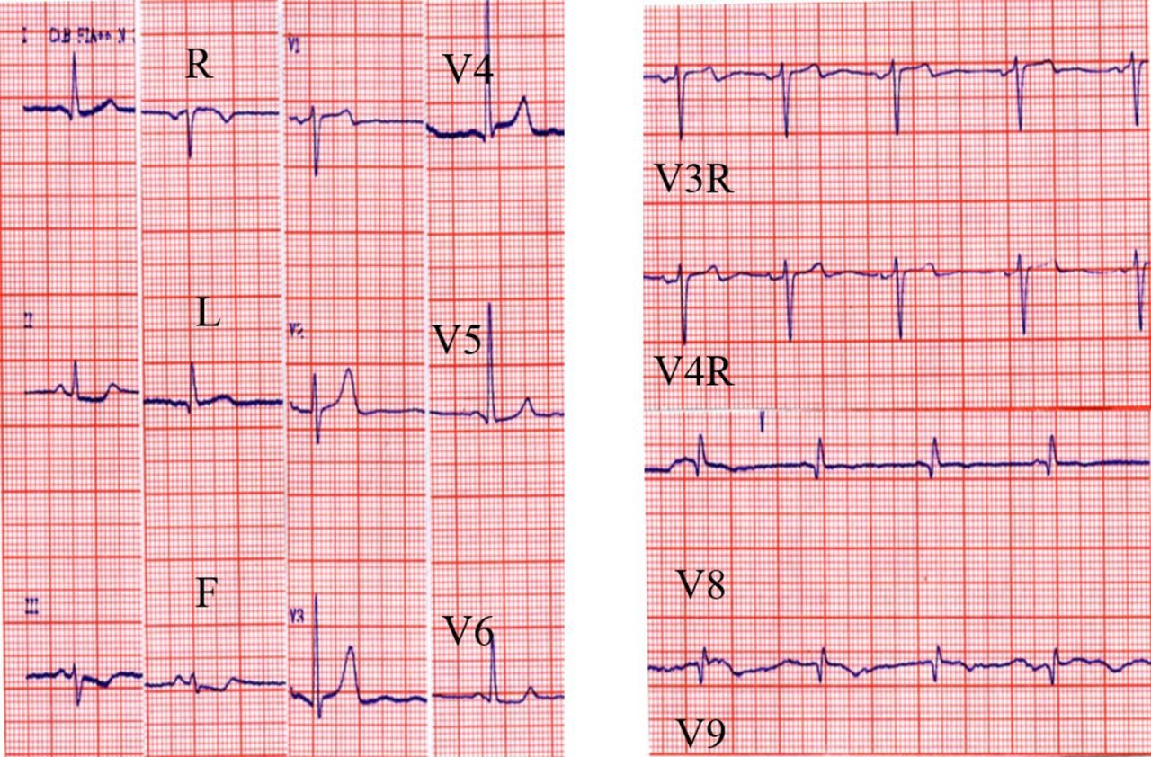 Paciente diabético con malestar retroesternal en quién las derivaciones posteriores del ECG permiten inferir el compromiso de la Cx