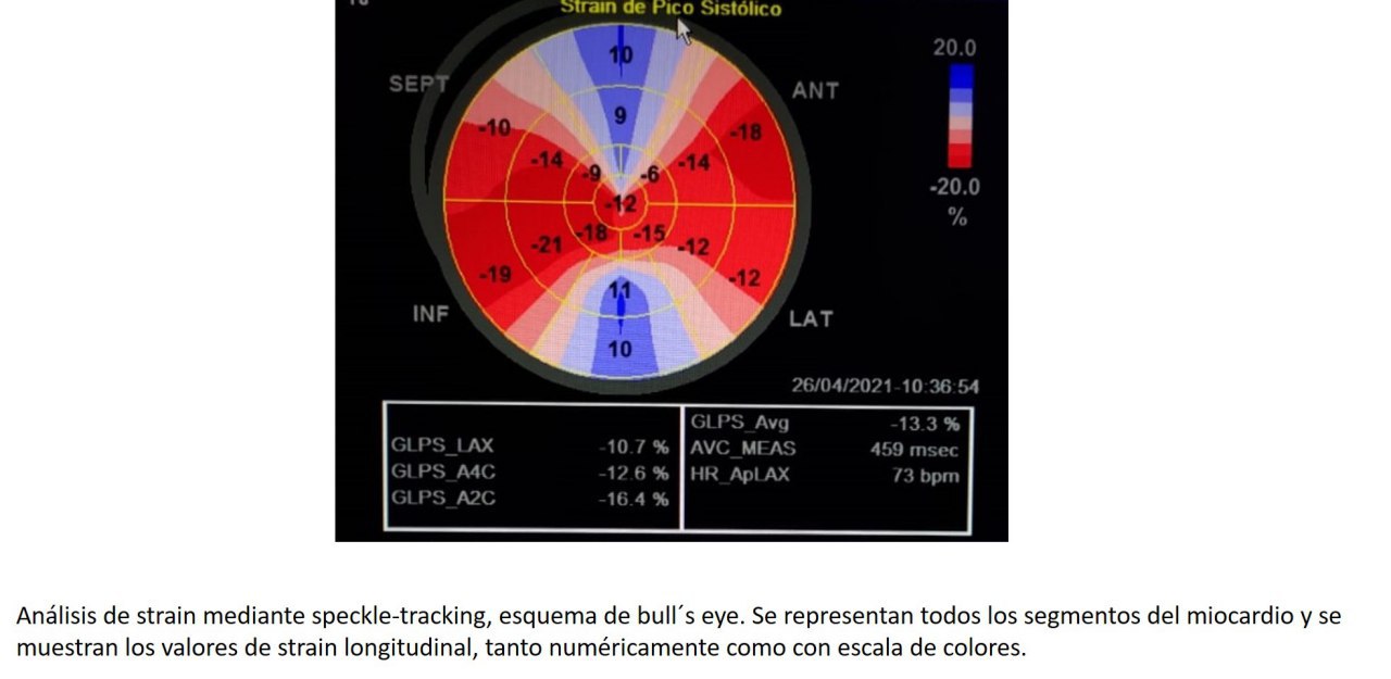 Paciente de 60 años, DBT, HTA, con antecedente de implante de dos stents en la DA que consulta por episodio de ángor y disnea, que realiza gammagrafía y ecocardiograma normales, con strain longitudinal y Strain regional muy alterado y strain global afectados, cuya CCG presenta una lesión severa en la Dg a la que se practica angioplastia con balón farmacológico, ya que era muy fina). DA con alteración de la FFR a la cual se colocó un stent intra-stent.