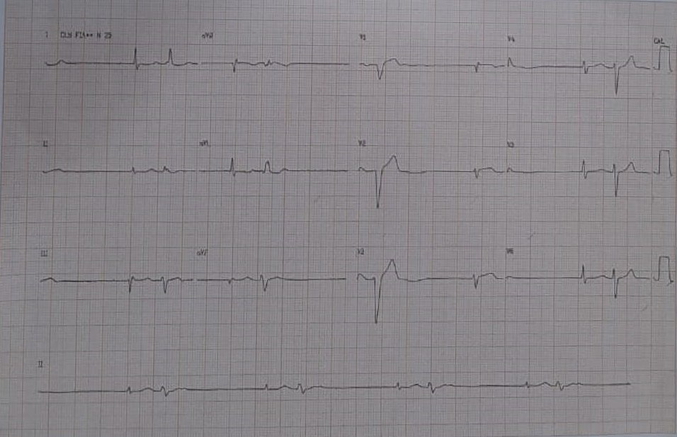 Hombre de 64 años internado con neumonía por COVID que cursa con bradicardia persistente por ritmo nodal que desarrolla RIVA y TV polimorfa