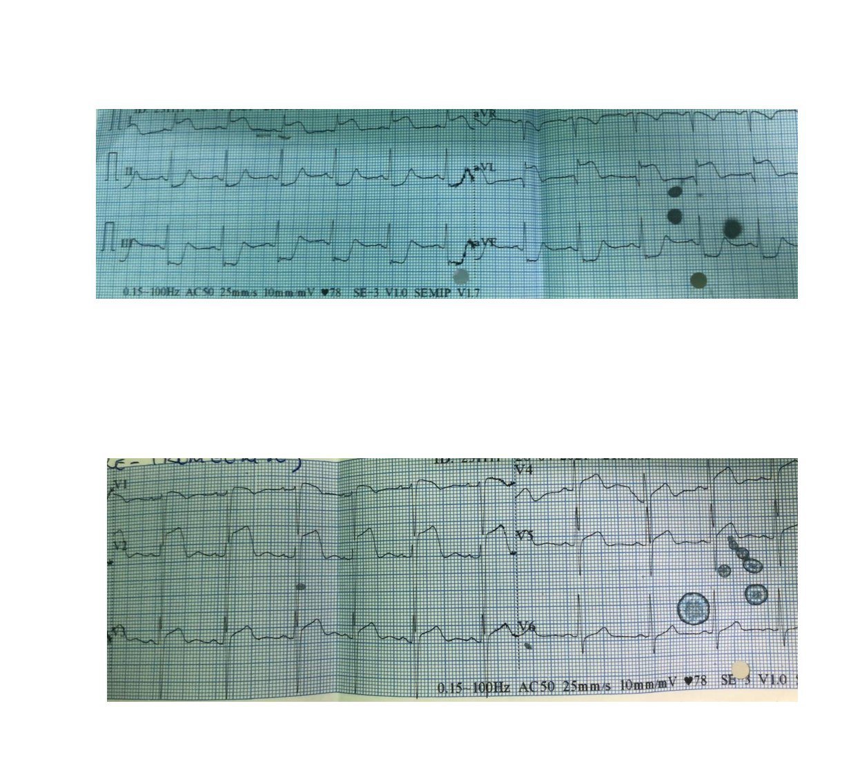 Varón de 32 años usuario de cocaína que presenta dolor precordial in crescendo, asociado a sudoración e hipotensión que es tratado con tenecteplase, que presenta CCG normal, interpretándose el cuadro como espasmo coronario con desarrollo ulterior de elevación del ST y TV