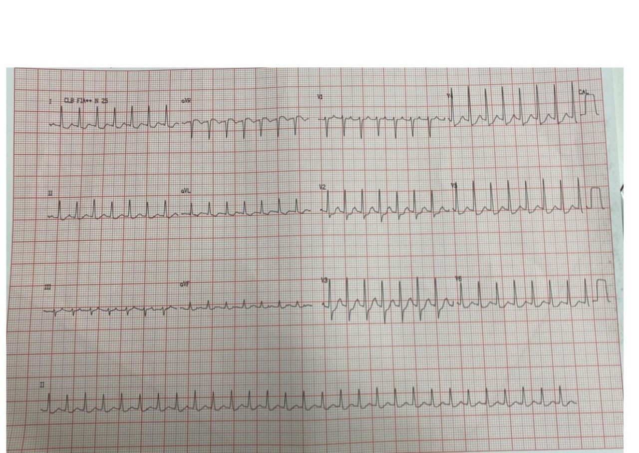 Paciente varón de 78 años con recurrentes episodios de taquicardia AV ortodrómica, observándose supradesnivel ST en aVR y reversión espontánea de la arritmia