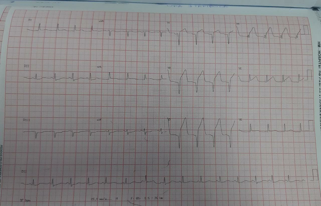 Masculino, 54 años que presenta episodio de ángor intenso, con sudoración, piel fría, agitación y disnea siendo trombolizado con tenecteplase 5 horas después, ingresando al Hospital con IAM en evolución con signos de reperfusión incompleta; repite el episodio al día siguiente cuando se practica CCG que muestra DA subocluída con ectasía proximal y alta carga de trombo