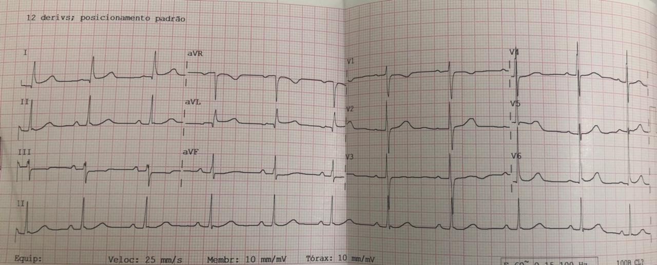 Paciente de 71 años que presenta ACV al despertar,  por oclusión proximal de la arteria cerebral media derecha, con patrón de repolarización precoz en el ECG