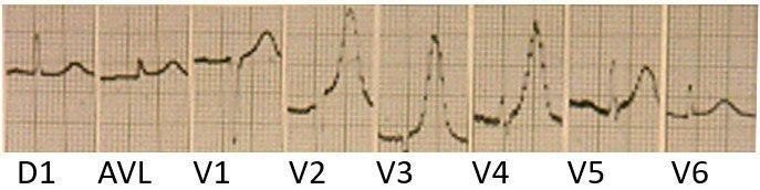 Hombre de 67 años que fue asistido con síndrome coronario agudo, con ángor prolongado, que recibe trombolisis tardía