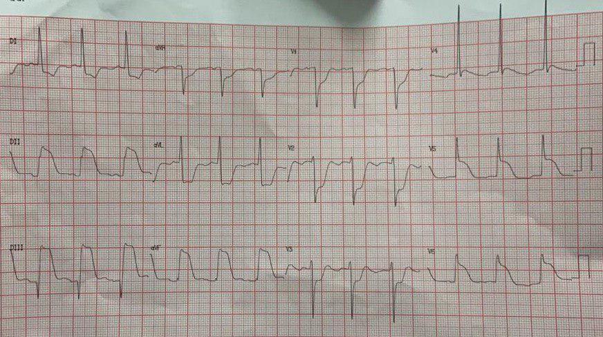 Mujer de 63 años, HTA y DBT con sospecha de COVID 19 que presentó un episodio de ángor prolongado trás la ingesta de un pastel que presenta alta carga de trombo en la coronaria derecha con embolización distal e imagen ECG de «casco prusiano»