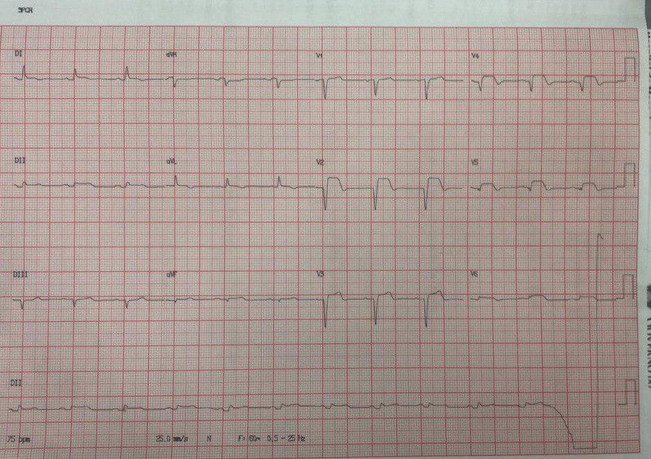 Mujer de 79 años, hipertensa, diabética y dislipémica con dolor torácico opresivo severo tras estrés emocional que presenta arterias coronarias normales con imagen que permite establecer el diagnóstico de síndrome de TakoTsubo