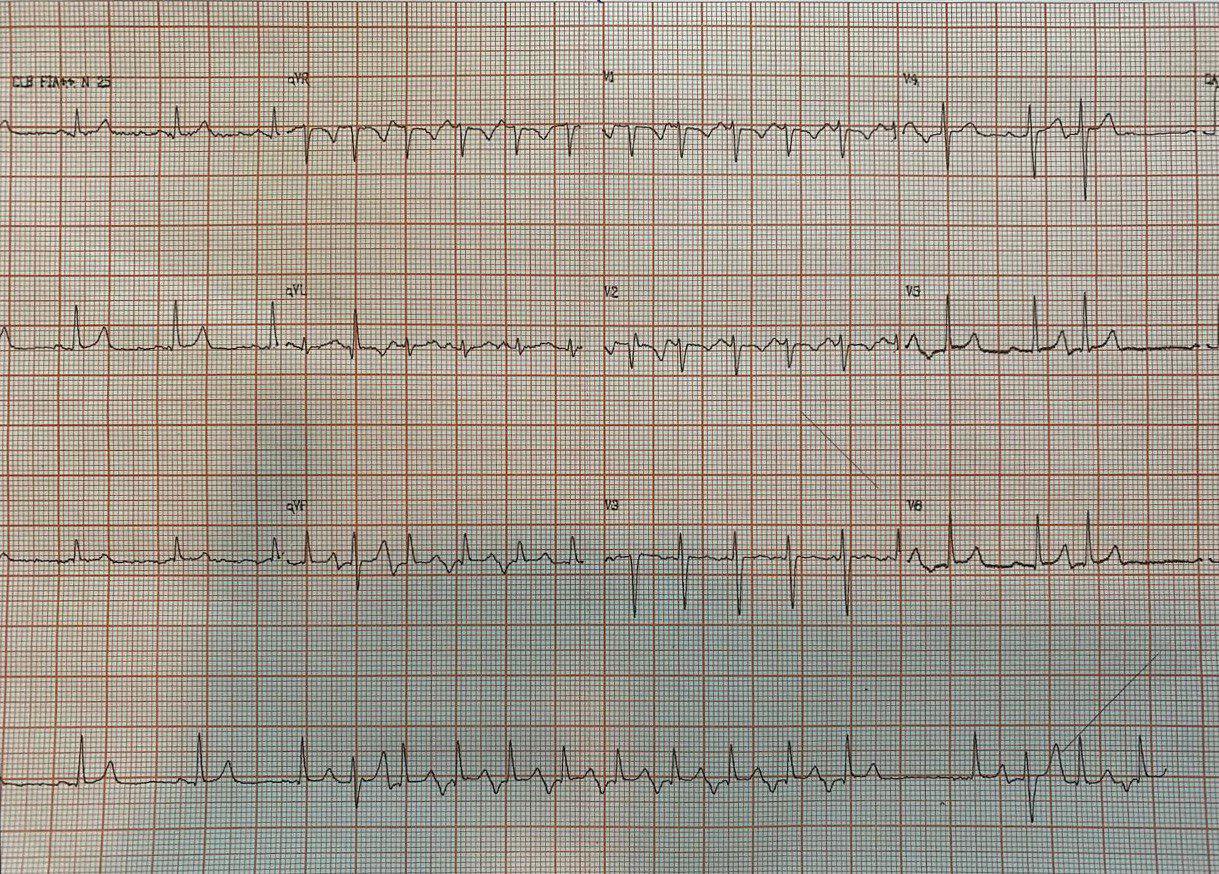 Adolescente de 14 años con palpitaciones que presenta taquicardia de complejos angostos con RP largo por probable taquicardia reentrante mediante una vía de conducción lenta VA