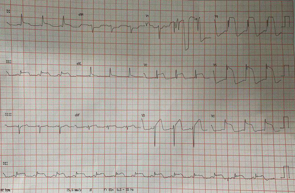 Mujer de 61 años, HTA y DBT con repentino episodio de ángor intenso, cuya CCG no mostró lesiones obstructivas signifivativas que se interpretó como síndrome de TakoTsubo