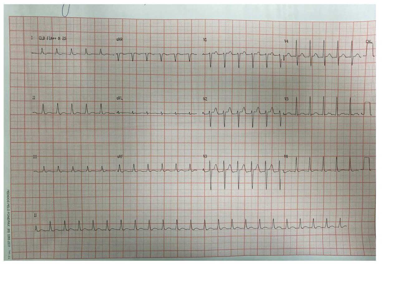 Paciente de 39 años con palpitaciones que se corresponden con una TSV en un síndrome de WPW