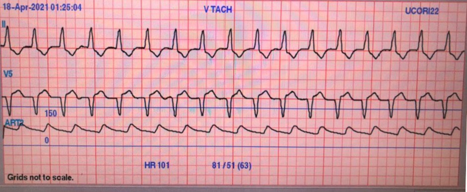Paciente de 77 años cursando SRA por COVID 19 con importante compromiso pulmonar que desarrolla TV