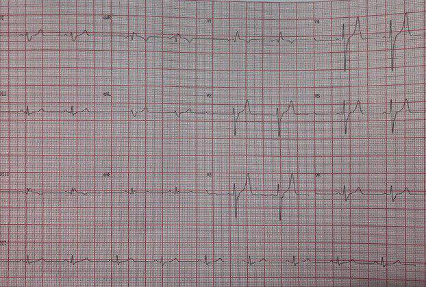 Mujer de 82 años con DM2, enfermedad renal crónica no dialitica y anemia crónica que fue internado con SCASEST que se trató con stent en la DA, detectándose severa hiperK y elevación de creatinina, con mejora ECG después de una sesión de hemodiálisis y se realiza test ergométrico