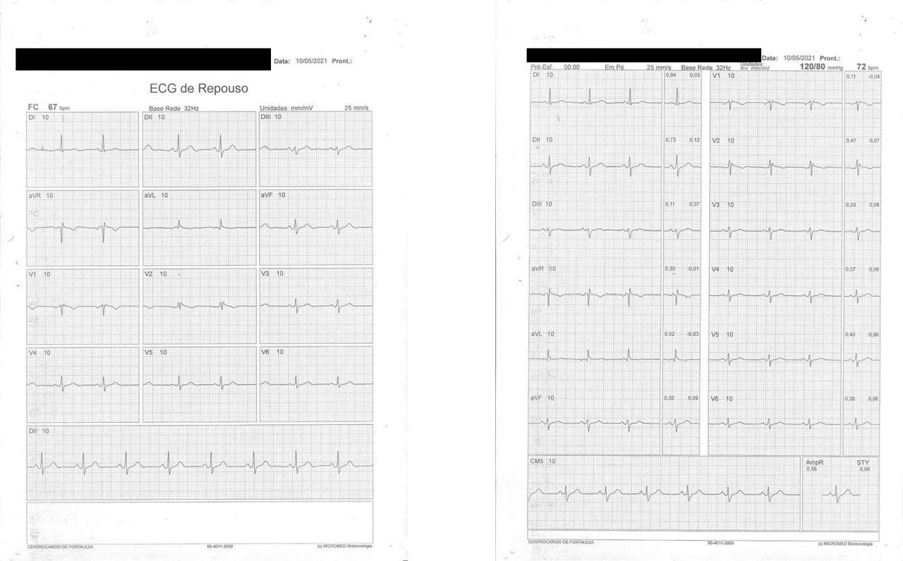 Prueba de esfuerzo de rutina en una paciente de 62 años asintomática tratada con litio y quetiapina cuyo ECG con imagen de síndrome de Brugada se interpreta como SrB inducido por drogas (litio) o ¿fenocopia?