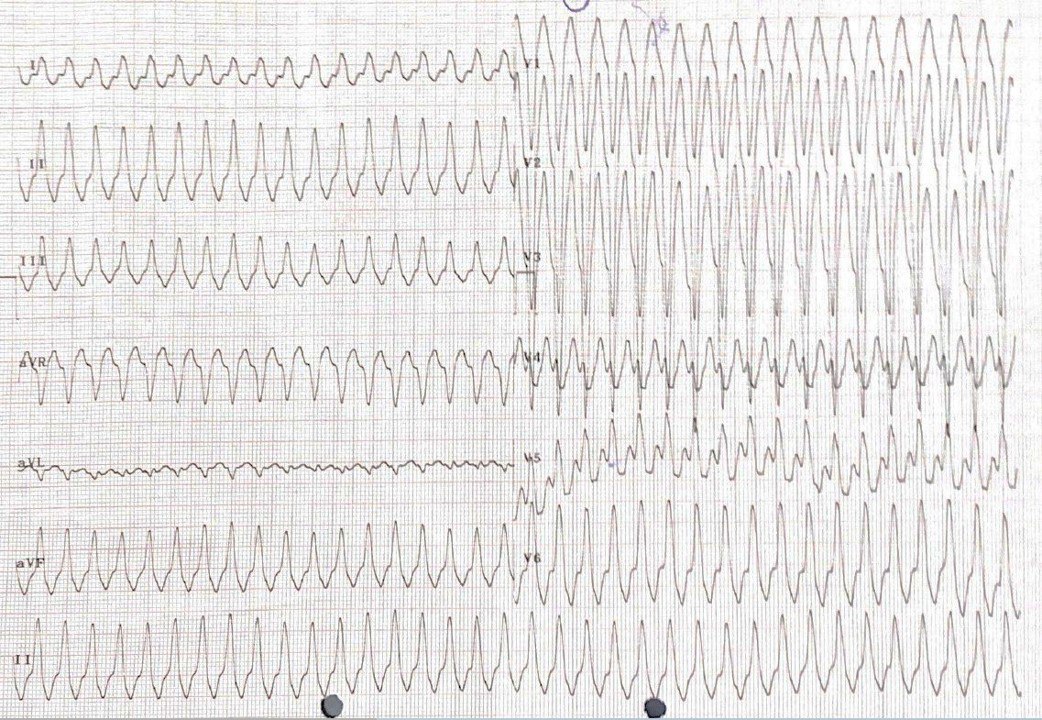 Consumidor de cocaína de 47 años con palpitaciones, disnea y diaforesis, por desarrollo de TSV que revierte con adenosina