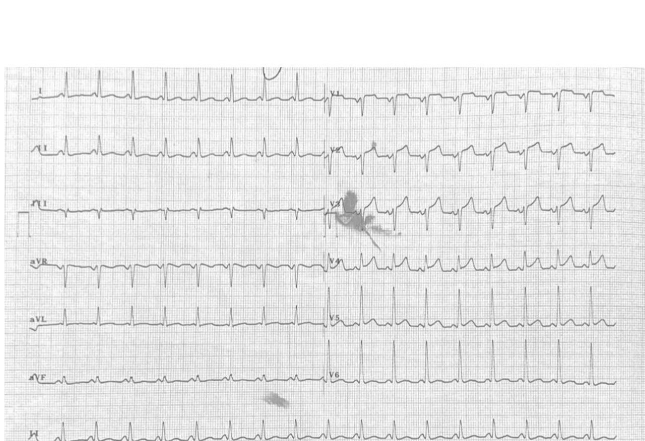 Adenosina pone de manifiesto la existencia de una vía accesoria sobre la que existían dudas