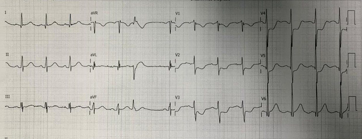 Paciente de 71 años, HTA y DBT que presenta episodio de ángor prolongado, cuya CCG mostró:  ⦁  rama diagonalis de gran importancia con 100% de obstrucción,  ⦁  circunfleja 95% de obstrucción proximal, ⦁  descendente anterior con 70% de lesión obstructiva en la porción media