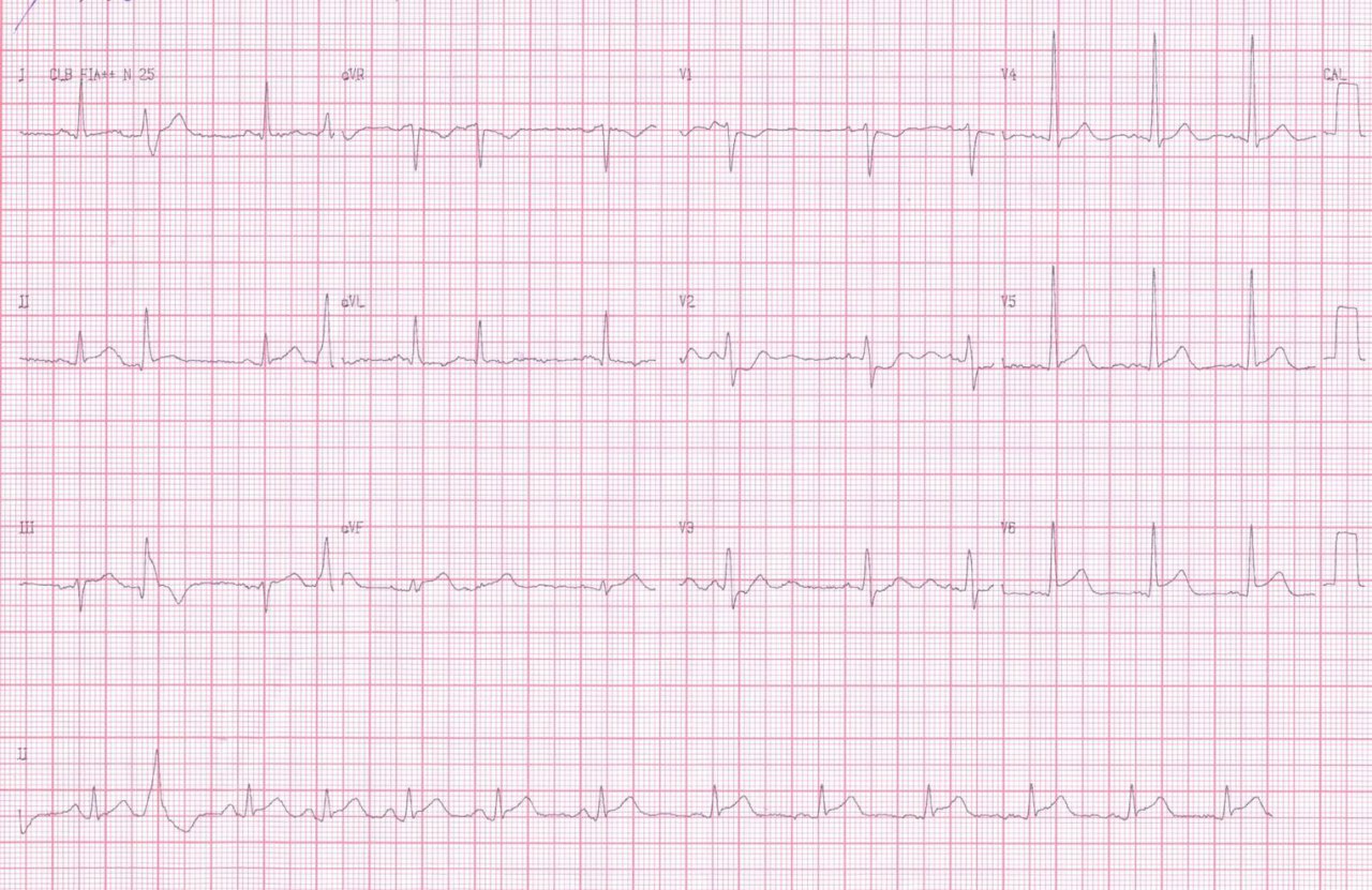Paciente cursando SCA por compromiso de CD y Cx