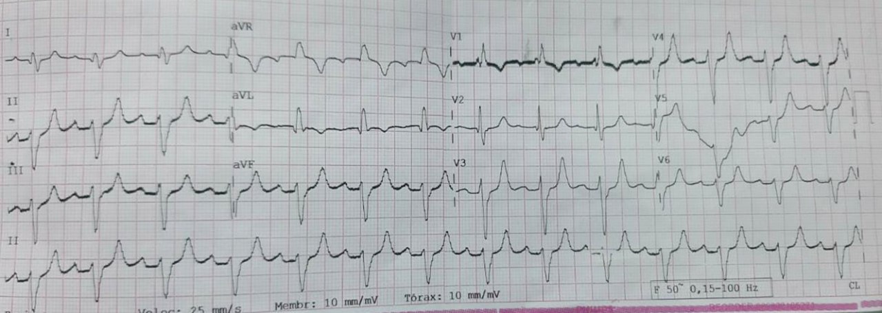 Mujer de 84 años, HTA y DBT insulinodependiente, ERC en diálisis que no acudió a la clínica y se perdió 1 sesión de hemodiálisis, que refiere malestar en el pecho y en quién se constata K = 8 mEq/l y BAVC que requiere estimulación, por compromiso de CD y DA