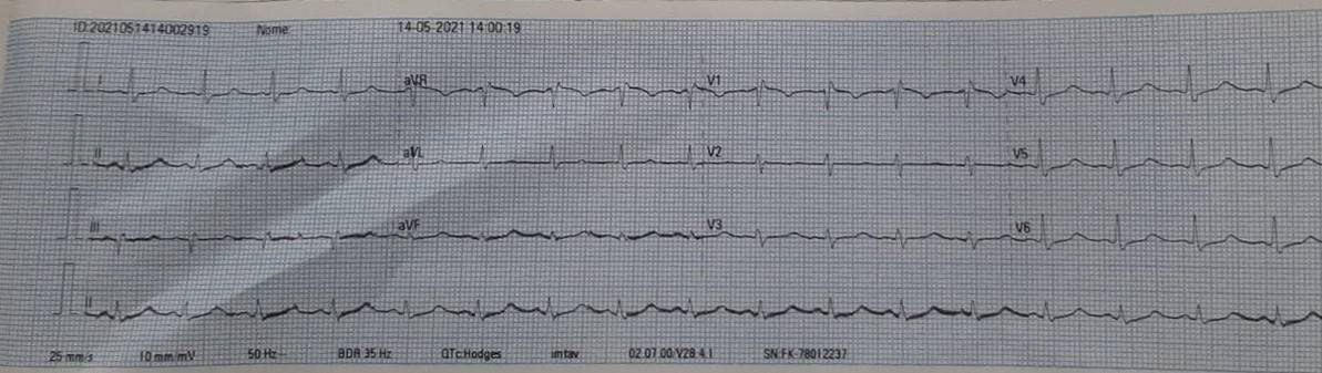 Paciente con severa insuficiencia respiratoria por TEP, con 80% de deterioro pulmonar en la TAC, con imagen de VI en forma de letra D y presencia de trombo y dímero D = 5000, con buena respuesta al tratamiento trombolítico