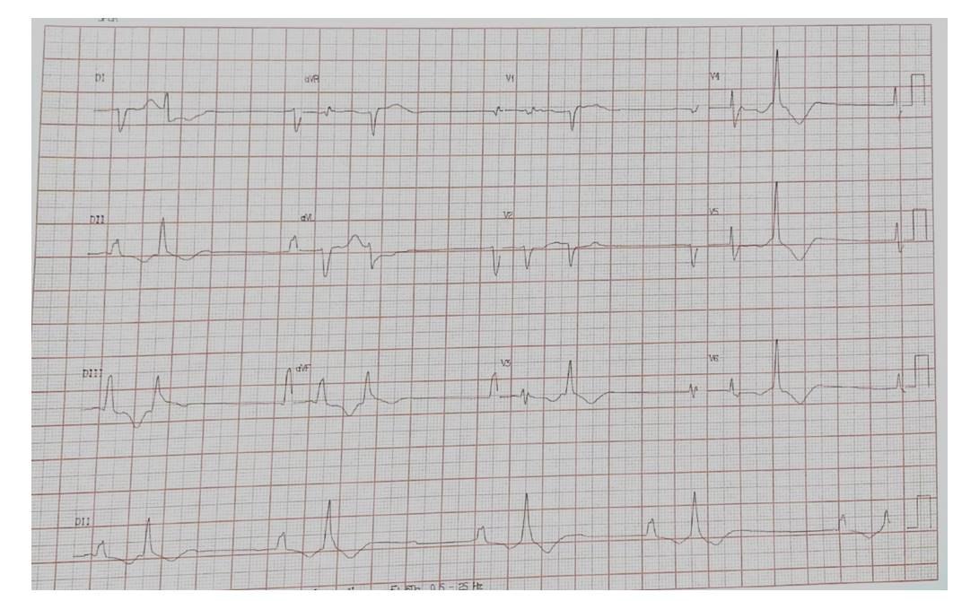 Paciente de 67 años, HTA e hipotiroidea, con mareos desde hace una semana previa en quién se detecta BAVC por enfermedad de Lev
