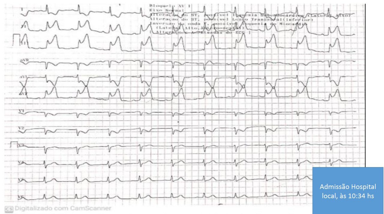 Mujer de 54 años sin antecedentes, que presenta episodios anginosos con franco supradesnivel del segmento ST en derivaciones inferiores, que ceden con nitratos. Un año antes ante episodio similar fue trombolizada con tenecteplase siendo la CCG totalmente normal siendo interpretado como Prinzmetal