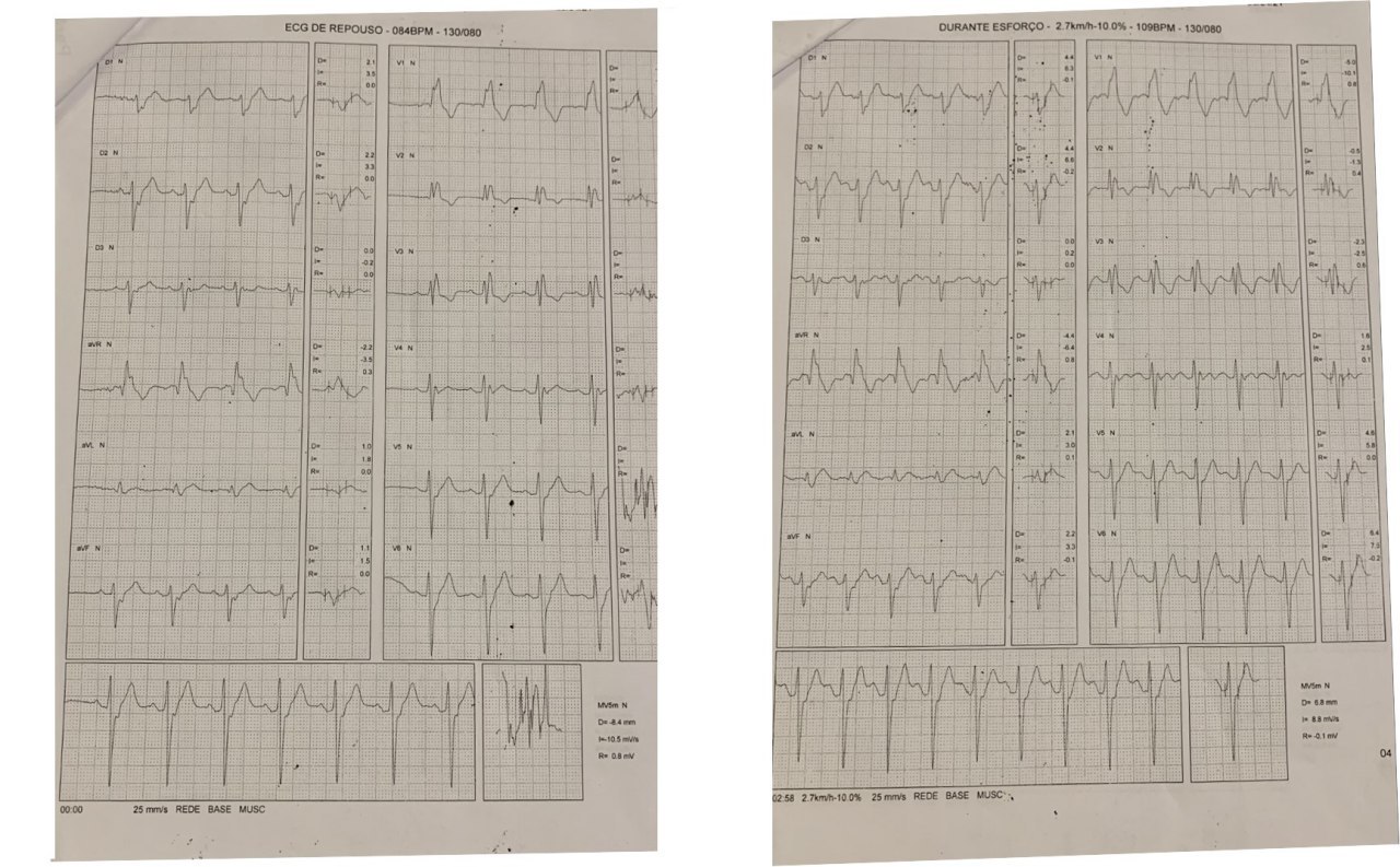 Paciente asintomático de 58 años. Durante prueba ergométrica de rutina presentó malestar y turvación visual, constatándose la presencia de un ritmo de escape ventricular que sugiere que la conducción distal infrahisiana  está afectada (enfermedad de Lev)