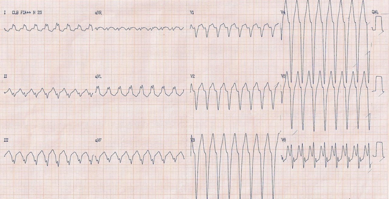 Paciente con historia de disnea y palpitaciones con VI dilatado y FEy = 37% que presenta una TPSV con aberrancia (¿AA o TRAVO?) en contexto de BIA-A