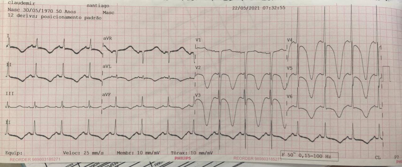 Paciente de 50 años, alcohólico y fumador, que ingresa con menor nivel de conciencia y un informe de crisis convulsiva durante el transporte a la unidad. presentando ECG con ondas T de tipo cerebral por severo ictus hemorrágico