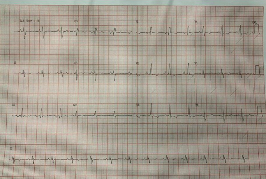Mujer, 32 años sin comorbilidades, que presenta disnea de esfuerzo desde hace 2 años con empeoramiento progresivo desde hace 1 mes, que evolucionó a pequeños esfuerzos + anasarca, debido a hipertensión pulmonar tromboembólica crónica (HPTEC)