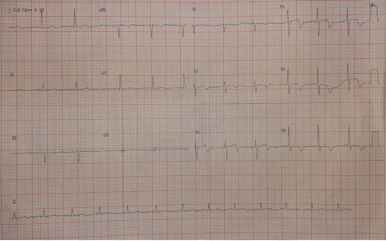Hombre de 60 años con ángor recurrente en las últimas semanas por oclusión crítica proximal de la DA
